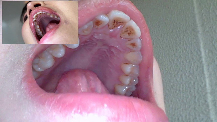 「【口腔観察】歯・舌・喉をじっくり接写!素人4名の口内フェチ動画55分セット」のサンプル画像7枚目