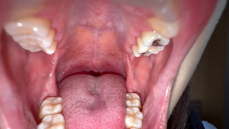 「【湊波流】素人お姉さんをナンパ!舌ブラシで汚舌苔採取する個人撮影動画」のサンプル画像7枚目